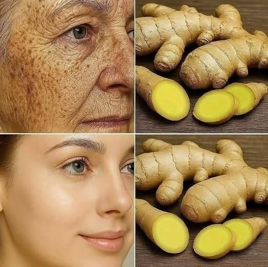 Le gingembre est 100 fois plus efficace que le Botox pour estomper les rides profondes, les taches de rousseur et les imperfections pigmentaires. Je tenais à vous le dire pour que vous continuiez à recevoir mes recettes… Merci ! 😍