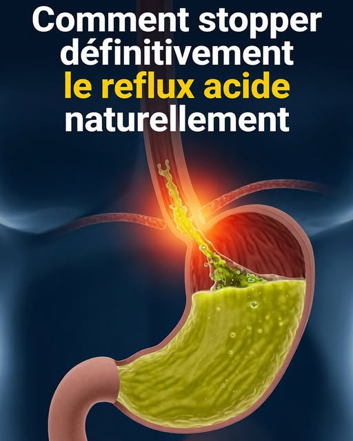3 façons d’arrêter le reflux acide naturellement
