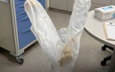 Sous la douche, des fragments suspects s’échappent de son corps : ce que l’urologue a extrait après 30 ans d’accumulation a glacé tout le bloc